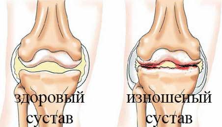 Рецепт целителя избавил мои суставы от боли!