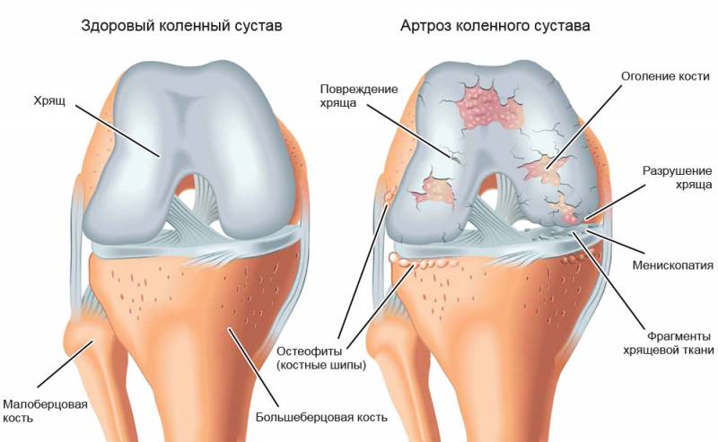 Рецепт целителя избавил мои суставы от боли!