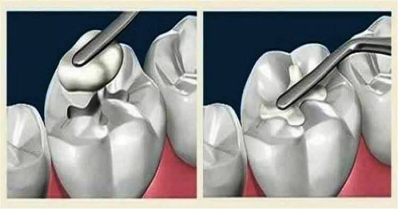 Ученые изобрели вечную пломбу, которая будет сама лечить зуб!