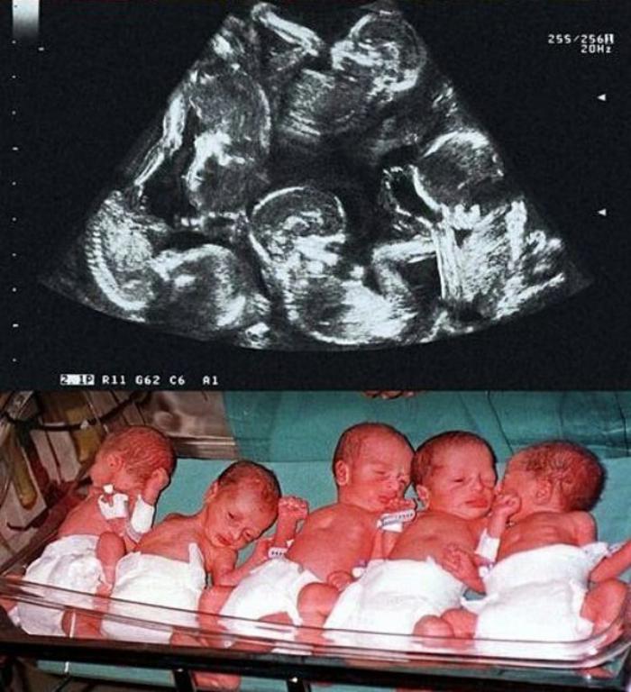 23-летняя мама родила деток, которые рождаются раз в 480 лет