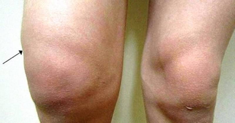 Болят колени: лечение народными средствами