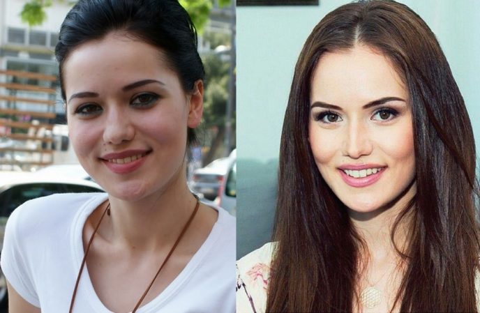 Знаменитые турецкие актрисы-красавицы, которые сделали пластику