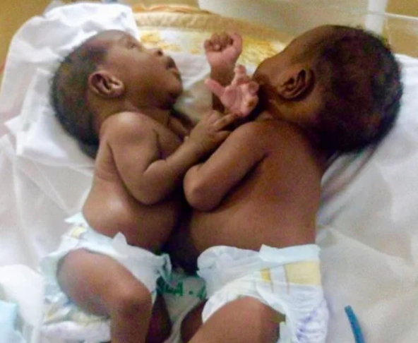 Сиамские близнецы родились у пары. Родители хотели отказаться от них, но судьба распорядилась по-другому