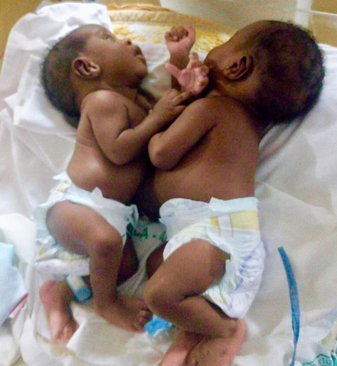Сиамские близнецы родились у пары. Родители хотели отказаться от них, но судьба распорядилась по-другому